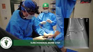 DCLAH Services - Subchondral Bone Cyst Surgery