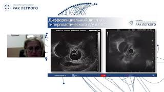 Современные возможности эндоскопии в диагностике новообразований интраторакальной локализации