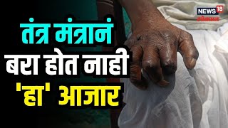 Leprosy Symptoms | पाप पुण्यामुळं होत नाही 'हा' आजार, ना तंत्रमंत्रानं होतो बरा | #local18