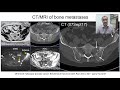 Bone metastases – One Disease with Many Signs