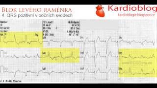 Kardioblog - Blok levého raménka Tawarova