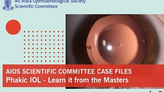 Case Files Phakic IOL -Learn it from the Masters