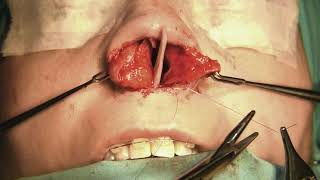 Hernan Chinski - CAUDAL SEPTAL REPLACEMENT GRAFT