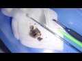 hardest granite like massive earwax removal raw u0026 extreme close up version