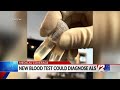 Scientist say they’ve developed a highly accurate blood test to detect ALS