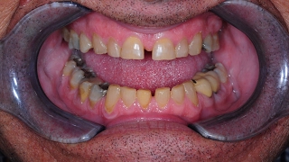 Full Smile Reconstruction with Jack Ringer DDS