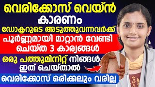 വെരികോസ് വെയിൻ മാറാൻ ദിവസം 10 മിനിറ്റ് ഇത് ചെയ്‌താൽ മതി|