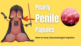 How to treat PEARLY PENILE PAPULES