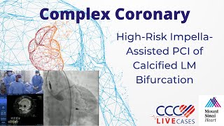 High-Risk Impella-Assisted PCI of Calcified LM Bifurcation