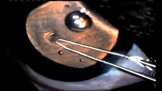 CCC continuous curvilinear capsulorrhexis. DOG