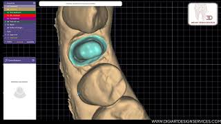 Pt 2 Tutorial : Post and Core Design Using exocad Supra-Structure