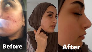 Choneti labrdni zibkai damuchawm | How I cleared up my acne |