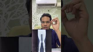 పిల్లలలో మోకాలు వంకర Knee deformity | Genu valgum | Bend in knee #rickets #deformitycorrection