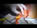 Elevation of thin Anterolateral thigh flap on superficial fascia plane by Jp (Joon Pio) Hong