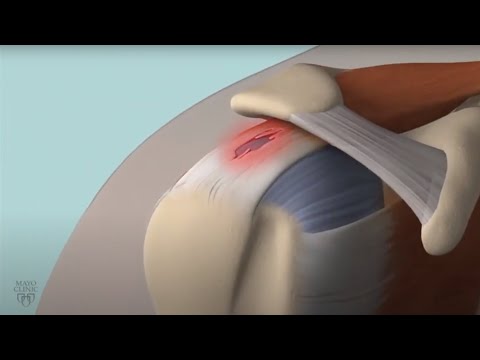 What is the muscle capping the shoulder and upper arm?