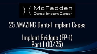 25 Amazing Dental Implant Bridge Cases (Part 1)