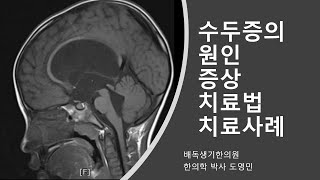 수두증 (Hydrocephalus) 강의 풀영상 : 수두증의 원인. 증상. 치료법. 수두증 치료케이스 강의, 소아수두증. 성인 수두증 치료법. 뇌척수액. 션트수술. 인지.발달장애.