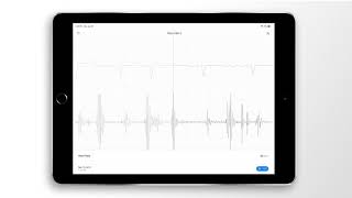 Atrial Fibrillation Combined Heart Sound, PCG \u0026 ECG Example - EkoCLINIC App