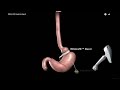 Gastric Banding Bariatric Surgery Animation