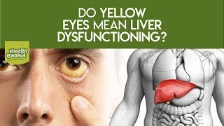 Do yellow eyes mean liver dysfunctioning?