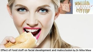 Effect of Food Stuff on Facial Development and Malocclusion by Dr Mike Mew