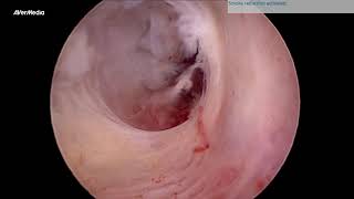 ENDOMETRIAL POLYP WITH THICKENED UTERINE ENDOMETRIUM