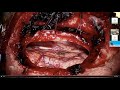 Surgery for Brainstem Cavernous Malformations by Michael Lawton MD | Neurosurgical TV