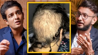 Before Getting A Hair Transplant, Watch This - Celebrity Dermatologist Dr. Abhishek Pilani