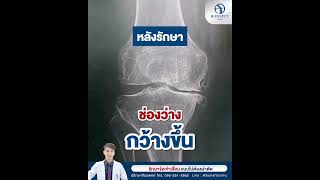 ผลลัพธ์หลังการรักษา ข้อเข่าดีขึ้นมาก ดูได้จากผล X-ray