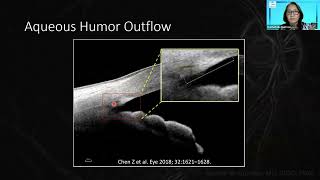 Understanding IOP Elevation - 2023 update