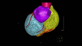 پشکنینی خوێنبەرەکانی دڵ بە بەکارهێنانی ئامێری تیشکی سی تی CT scan