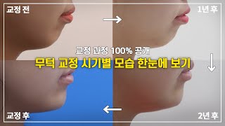 무턱 교정 과정 시기별 모든 모습들을 보여드리겠습니다!