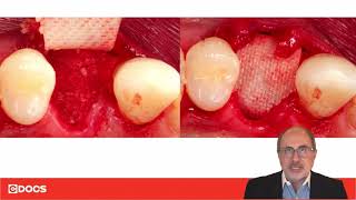 Tip of the Day: Double Membrane Socket Graft