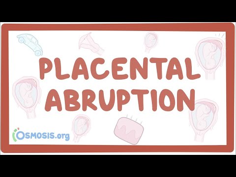 Can exercise cause placental abruption?