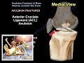 Avulsion Fractures & Bone Bruises Around The Knee - Everything You Need To Know - Dr. Nabil Ebraheim