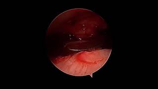 All-Arthroscopic Osteochondral Autograft Transfer Technique...