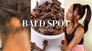 BALD SPOT UPDATE : Alopecia Areata Natural Treatment | Clove water Challenge | April Sunny