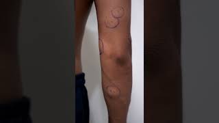 Lipoma Cure in Delhi | Multiple lipoma treatment #shortsvideo