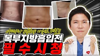 🔥복부 지방흡입 재수술이 많은 진짜 이유🔥 지흡 부작용 생기는 이유와 복부지흡재수술 case 및 해결방법에 대해 다 알려드릴게요! (liposuction revision/吸脂修复)