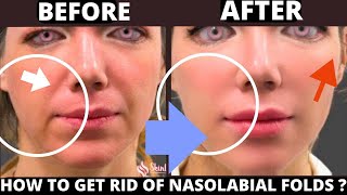 🛑 FACE EXERCISES FOR LAUGH LINES (NASOLABIAL FOLDS) SAGGY SKIN, JOWLS, FOREHEAD LINES, CHEEKS LIFT