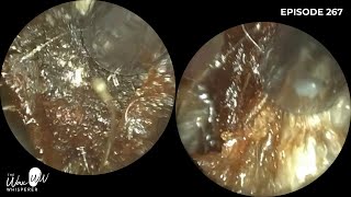 267 - Difficult Home Visit Ear Wax Removal using the WAXscope®️