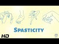 Spasticity: The Hidden Challenge for Individuals with Disabilities