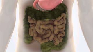 IBS-C disease