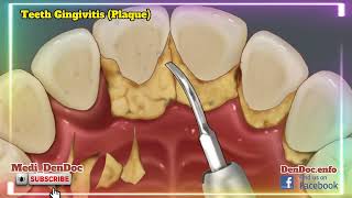 Teeth Gingivitis Gum Disease |#dentist #teeth #youtube ماسخورہ(مسوڑھوں کی بیماری )