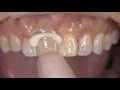 how to use kerr nexus rmgi resin modified glass ionomer cement