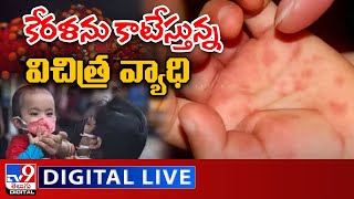 కేరళను కాటేస్తున్న విచిత్ర వ్యాధి LIVE | Tomato Flu In Kerala - TV9 Digital