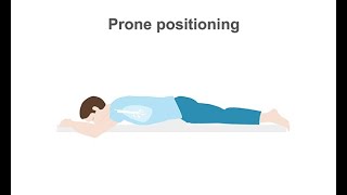 How to treat your intubated ARDS patients with prone positioning