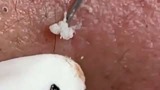 Blackheads Removal | Acne Treatment and Very Satisfying Satisfying Pimple pop #blackheads