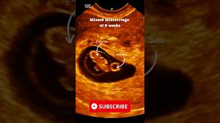 Missed Miscarriage at 8 Weeks Ultrasound Scan