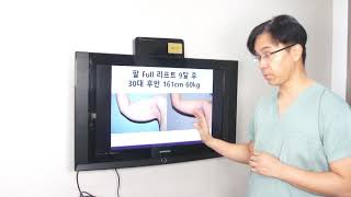 처진 팔뚝살 리프팅 [실루엣성형외과]